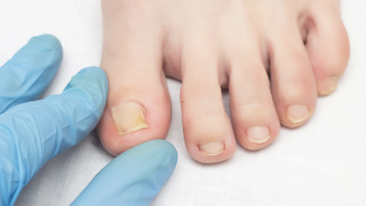 Nail Fungus Treatment Appointments in Owings Maryland